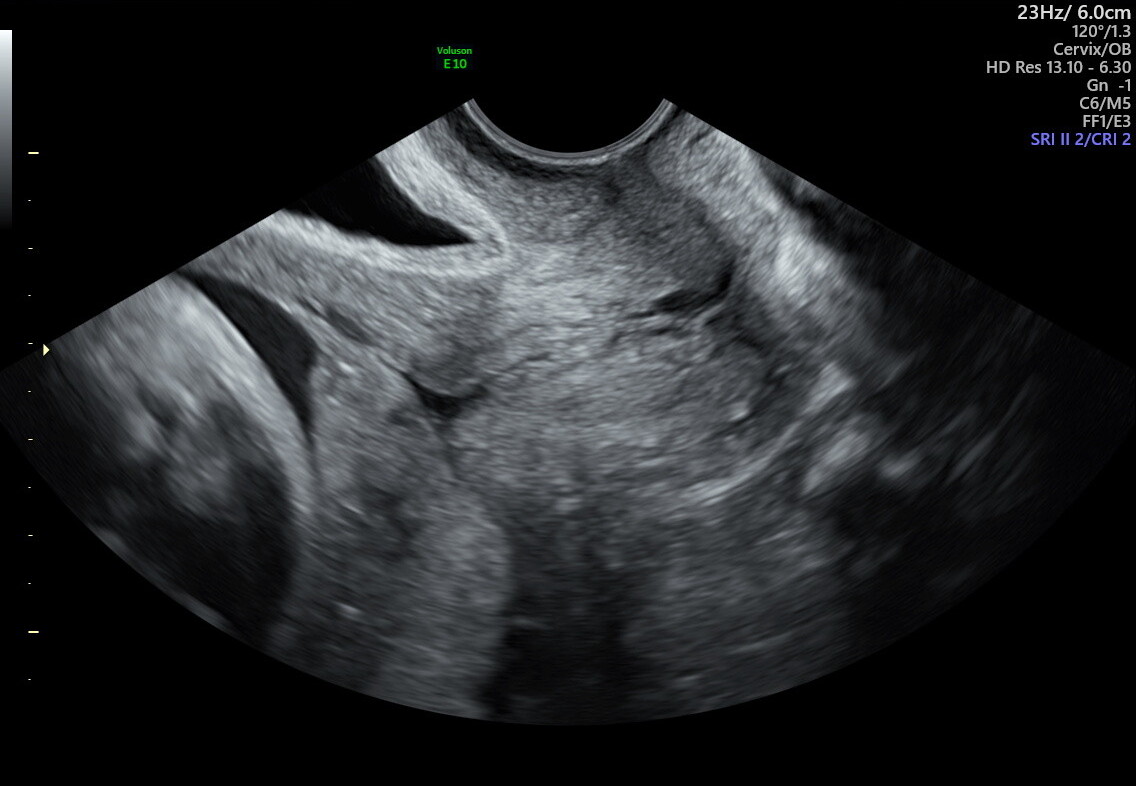 Transvaginal ultrasound showing complete placenta previa — the placenta covers the internal cervical os.