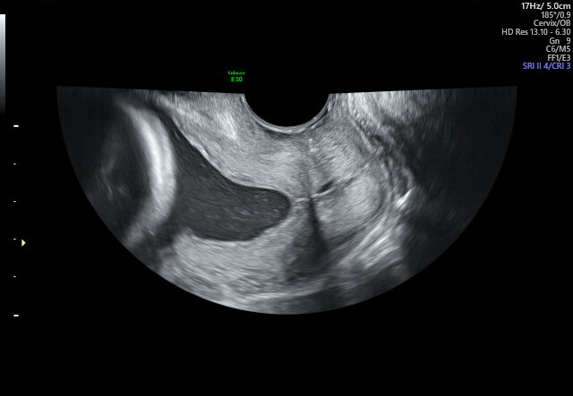 Transvaginal ultrasound of a funneling cervix — the internal os has opened into a V/U shape, indicating cervical shortening.