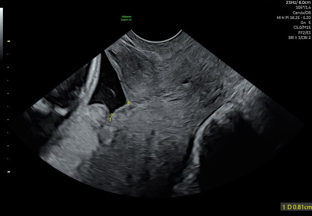 Transvaginal ultrasound showing a low-lying placenta — the placental edge sits 0.81 cm from the cervix, within the 2 cm threshold.