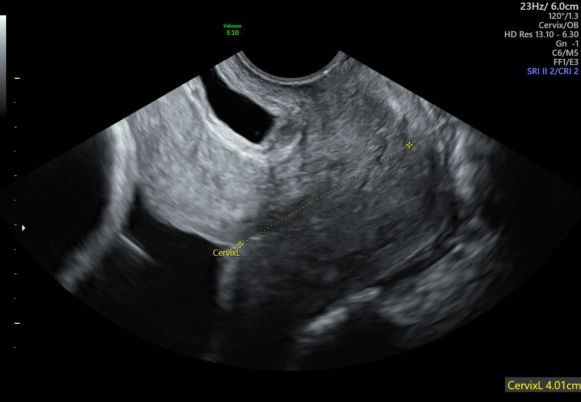 Transvaginal ultrasound of a normal cervix measuring 40.1 mm — well above the 25 mm threshold.
