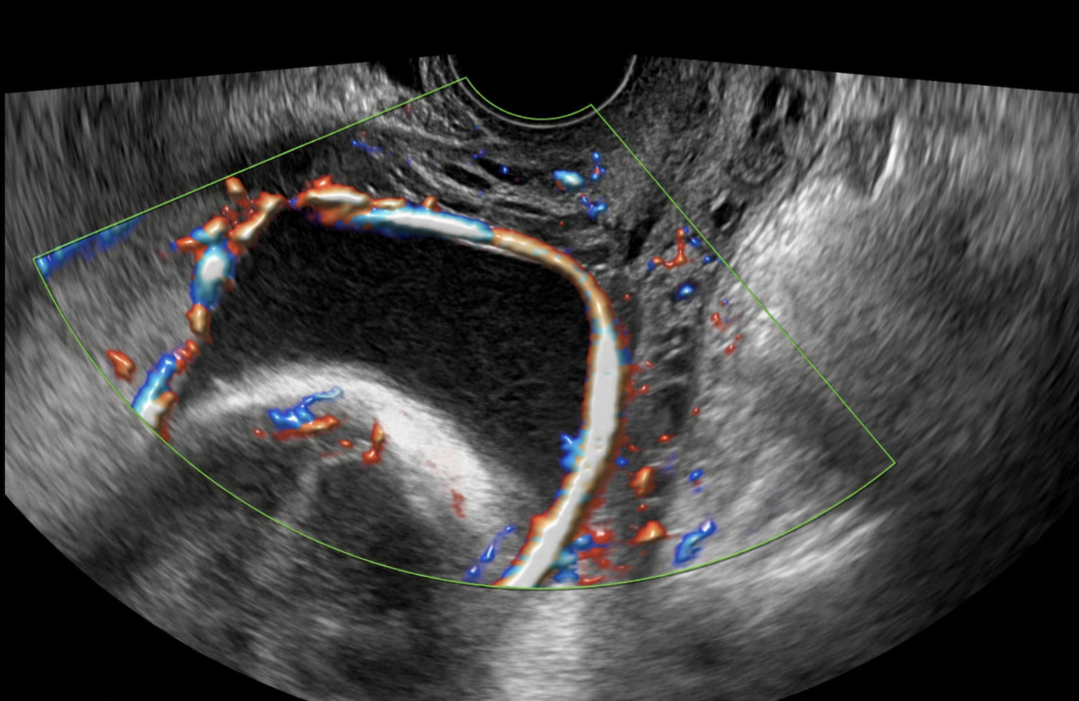 Transvaginal ultrasound with Color Doppler showing fetal blood vessels (red and blue flow) tracing the placental edge near the cervix.
