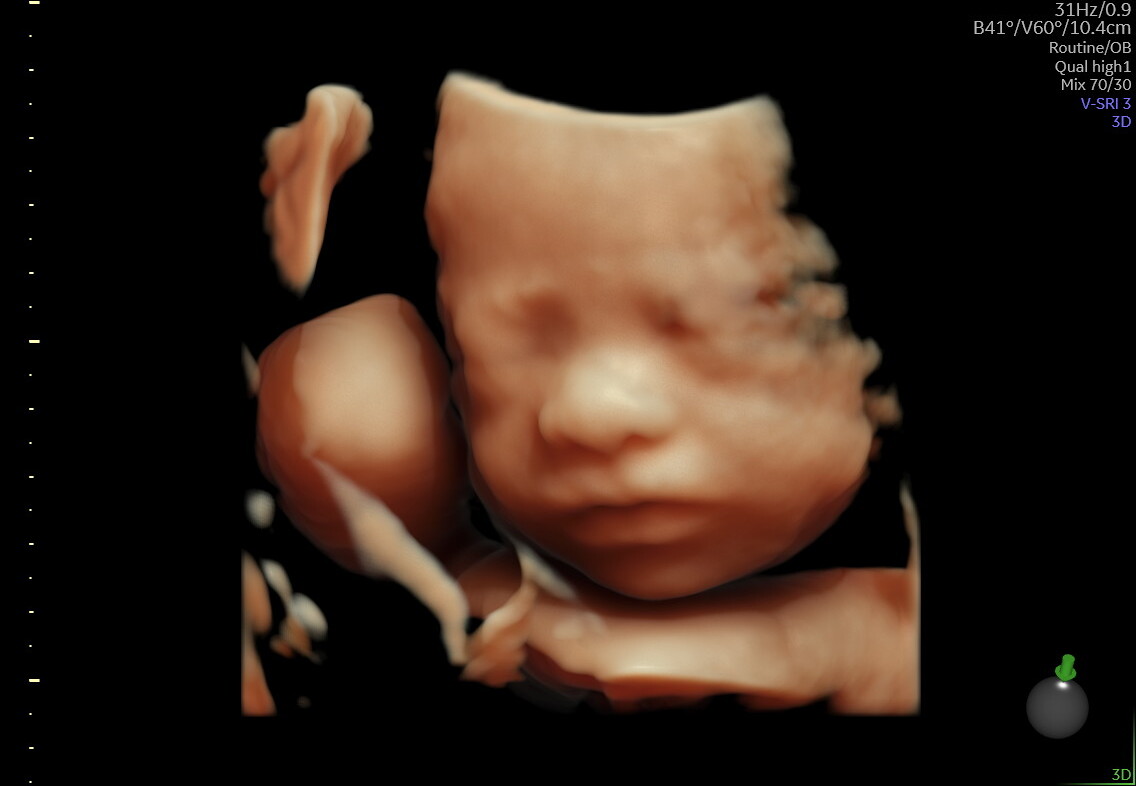 3D ultrasound portrait of a baby's face